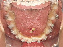 下顎sl-thumb-220x165